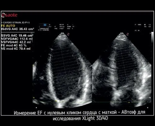 Клинические изображения УЗИ аппарат Esaote MyLab X8