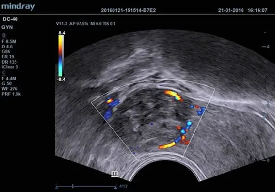 Клинические изображения УЗИ аппарат Mindray DC-40 Exp
