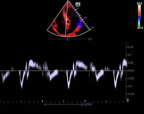 Клинические изображения УЗИ аппарат Mindray DC-70 Exp