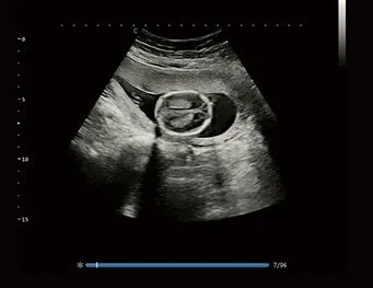 Клинические изображения Chison XBit 90 ультразвуковой аппарат