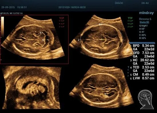 Клинические изображения УЗИ аппарат Mindray Resona 6 Exp