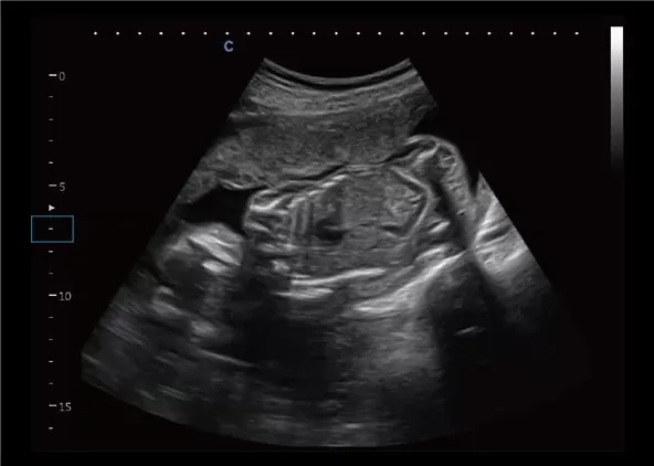 Клинические изображения УЗИ аппарат Chison CBit 4