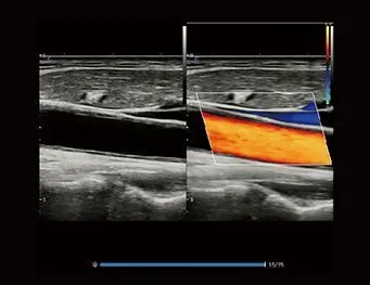 Клинические изображения Chison XBit 90 ультразвуковой аппарат