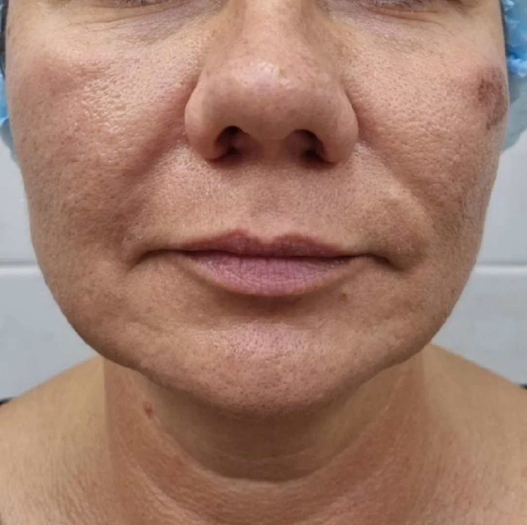 NeoGen омоложение анфас до.jpg