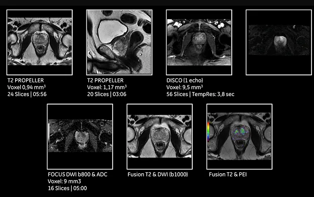 Клинические изображения МРТ аппарат GE SIGNA Pioneer 3T