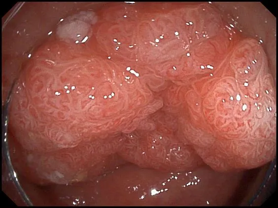 Клинические изображения SonoScape HD-320 видеоэндоскопическая система