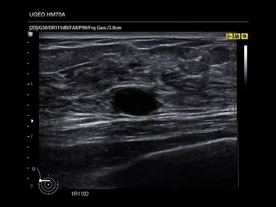 Клинические изображения Samsung Medison HM70A УЗИ аппарат портативный