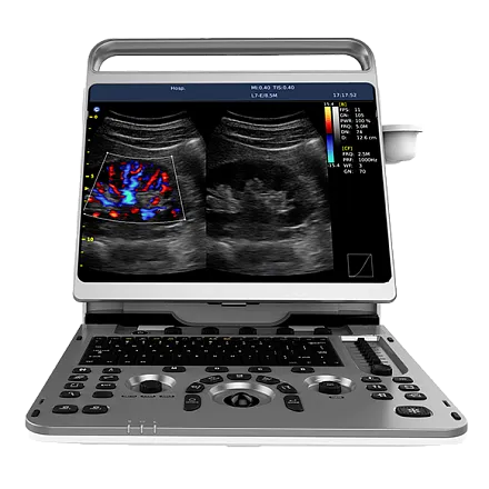 Chison EBit 50 ультразвуковой аппарат