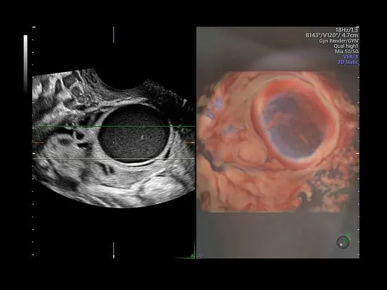 Клинические изображения Ультразвуковая диагностическая система GE Voluson E10