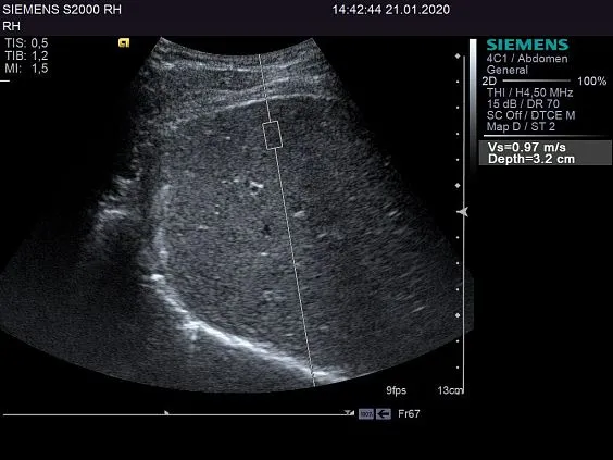 Клинические изображения Siemens ACUSON S2000 ультразвуковая система