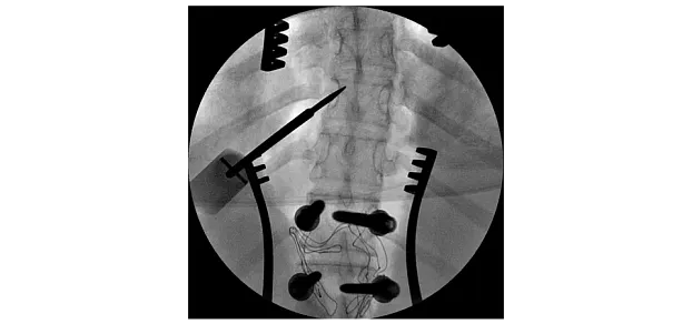 Клинические изображения Philips BV Vectra С-дуга