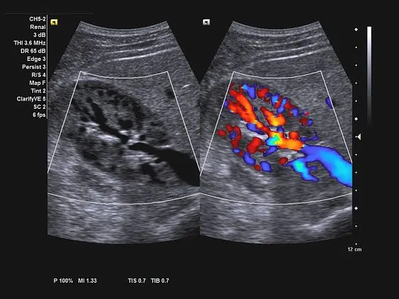 Клинические изображения Ультразвуковая система Siemens Acuson NX3 Elite