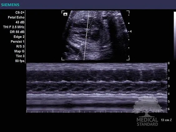 Клинические изображения Ультразвуковой аппарат Siemens Acuson X300 Premium Edition