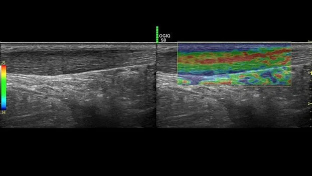 Клинические изображения GE Logiq S8 XDclear ультразвуковая диагностическая система