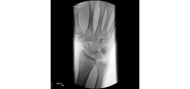 Клинические изображения Philips BV Pulsera С-дуга