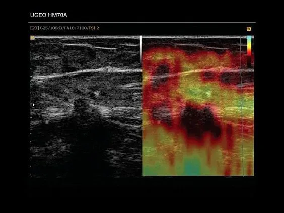 Клинические изображения Samsung Medison HM70A УЗИ аппарат портативный