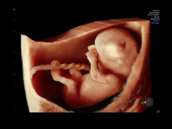 Клинические изображения Ультразвуковая диагностическая система GE Voluson E10