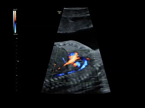 Клинические изображения GE Voluson S8 ультразвуковой аппарат