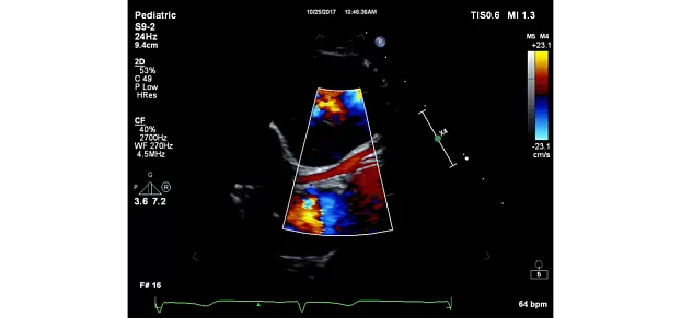 Клинические изображения Philips EPIQ CVx ультразвуковой аппарат