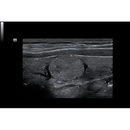 Клинические изображения УЗИ аппарат Mindray DC-70S