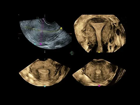 Клинические изображения УЗИ аппарат GE HealthCare Voluson P8