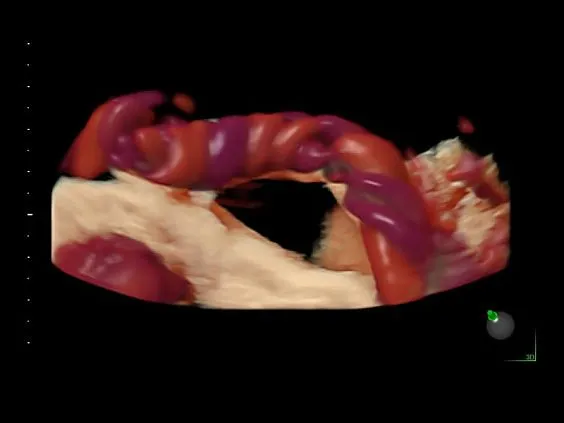 Клинические изображения Ультразвуковая диагностическая система GE Voluson E10