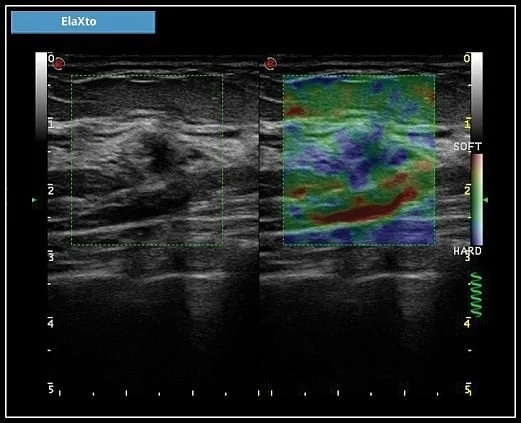 Клинические изображения УЗИ аппарат Esaote MyLab X6