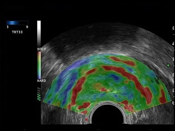 Клинические изображения УЗИ аппарат Esaote MyLab Eight