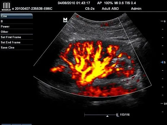 Клинические изображения УЗИ аппарат Mindray M7 портативный