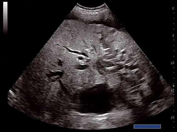 Клинические изображения УЗИ аппарат Esaote MyLab Twice