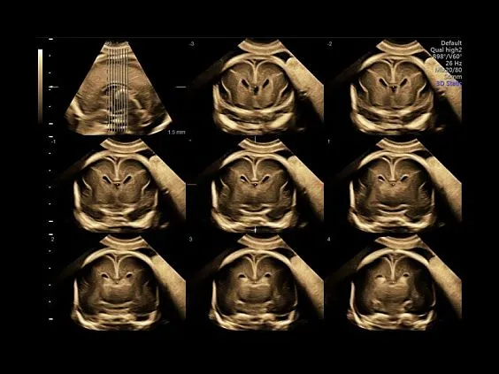 Клинические изображения Ультразвуковая диагностическая система GE Voluson E10