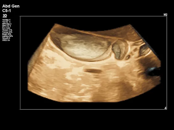 Клинические изображения Philips Affiniti 70 ультразвуковой аппарат