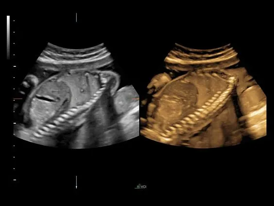 Клинические изображения Ультразвуковая диагностическая система GE Voluson E10