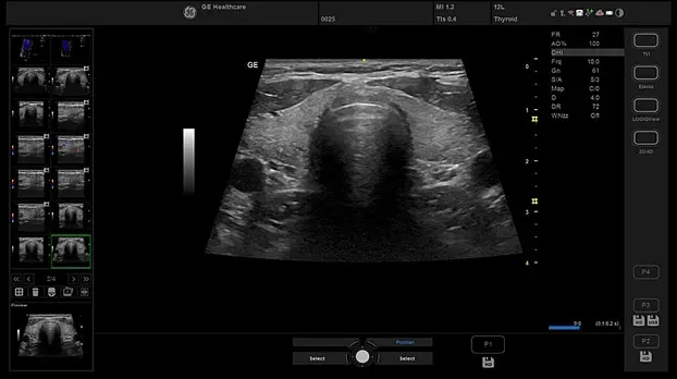 Клинические изображения УЗИ аппарат GE Healthcare Versana Essential 