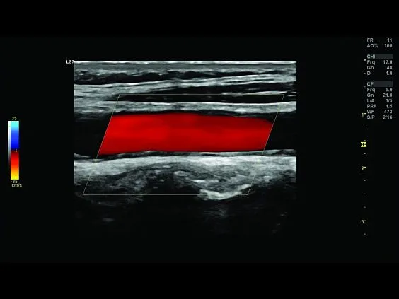 Клинические изображения Ультразвуковая диагностическая система GE Logiq S7 XDclear