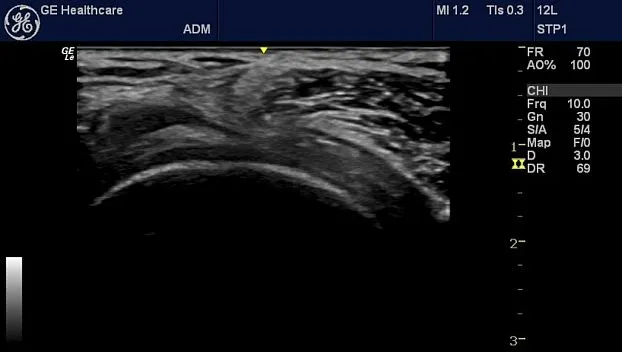 Клинические изображения Портативная ультразвуковая система GE HealthCare Logiq e