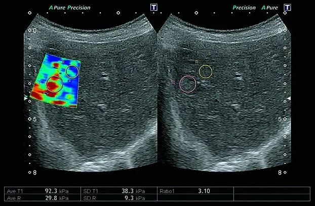 Клинические изображения Canon (Toshiba) Aplio 500 УЗИ аппарат