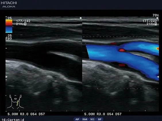 Клинические изображения УЗИ аппарат Fujifilm (Hitachi) Aloka ProSound F31