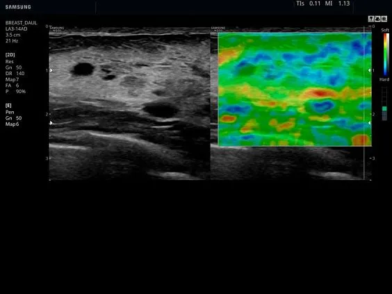 Клинические изображения Samsung Medison HS50 УЗИ аппарат