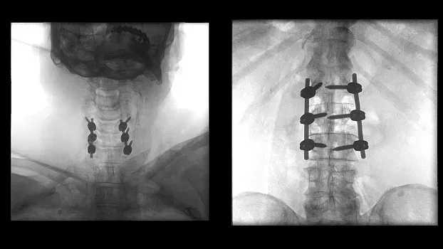 Клинические изображения Мобильный рентгенохирургический аппарат типа C-дуга Siemens Cios Flow