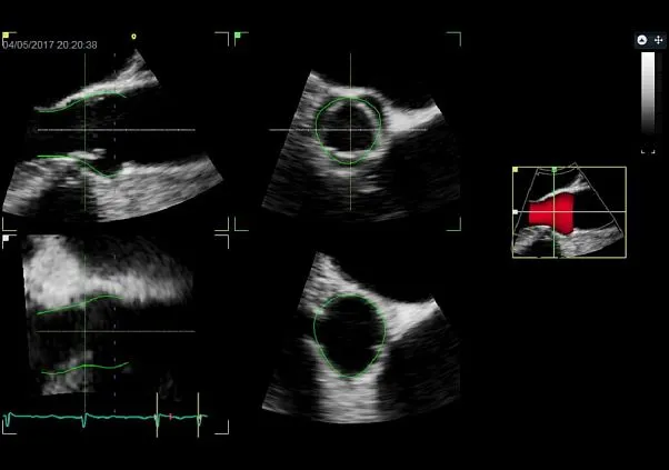 Клинические изображения Ультразвуковая диагностическая система GE HealthCare Vivid E95