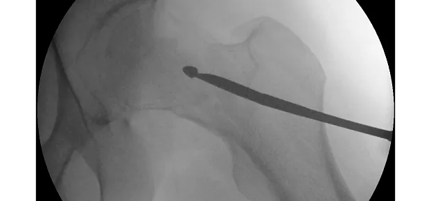 Клинические изображения Philips BV Pulsera С-дуга