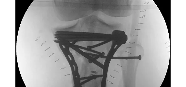 Клинические изображения Philips BV Pulsera С-дуга