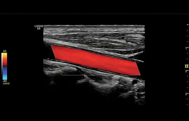 Клинические изображения УЗИ аппарат GE Healthcare Logiq E9 XDclear