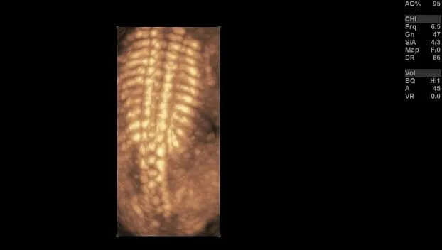 Клинические изображения GE Logiq S8 XDclear ультразвуковая диагностическая система