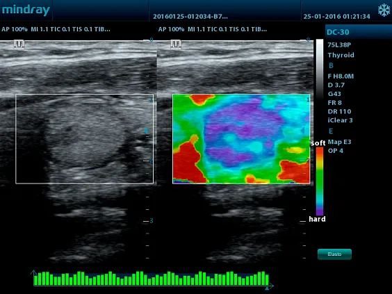 Клинические изображения УЗИ аппарат Mindray DC-30