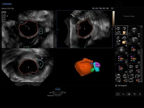 V6-RUS: Фолликулы яичника, 5D Follicle