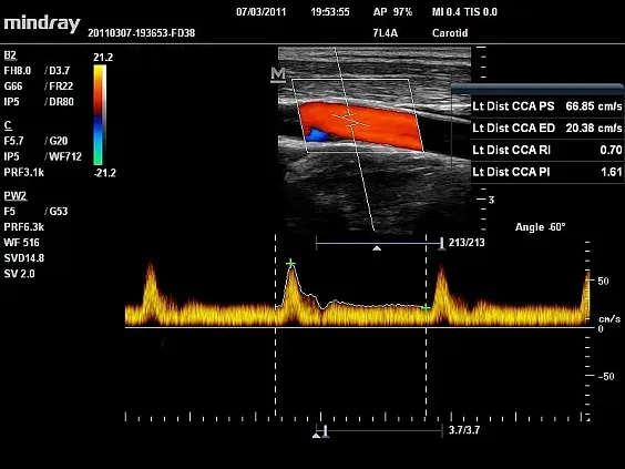 Клинические изображения УЗИ аппарат Mindray DC-N6