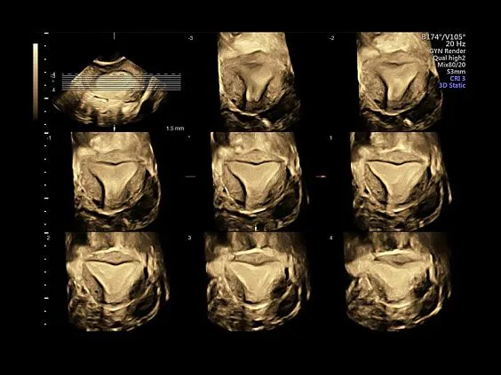 Клинические изображения GE Voluson S6 аппарат УЗИ