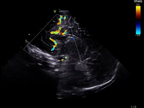 Клинические изображения Ультразвуковая диагностическая система GE Vivid S60